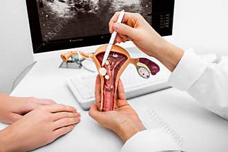 Close-up anatomical model of the uterus with pathologies. Gynecologist showing the polyps of the uterus.