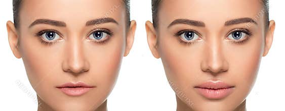 Female face before and after procedure lips augmentation