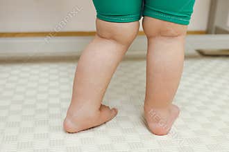 A child with valgus deformity of feet and hypermobile joints of foot stands in rehabilitation center, close-up