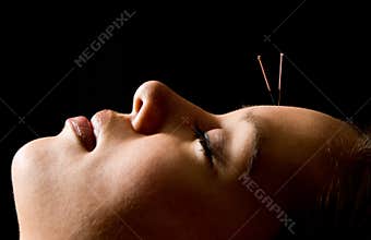 Acupuncture