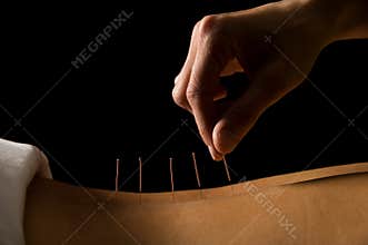 Acupuncture