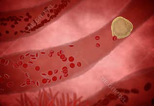 Clogged Artery with platelets and cholesterol plaque, concept for health risk for obesity or dieting and nutrition problems