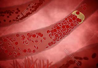 Clogged Artery with platelets and cholesterol plaque, concept for health risk for obesity or dieting and nutrition problems