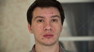 Man with Acne