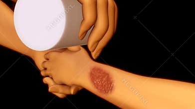First aid for first degree burns