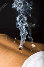 Burning moxa on male patient