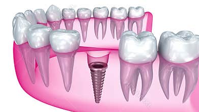 Tooth implant installation , Medically accurate