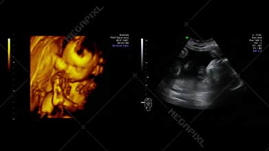 Fetal Sonograms Pictures