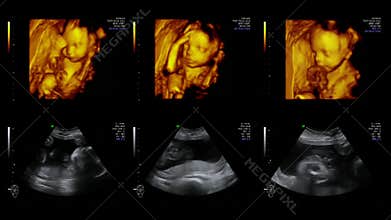 Ultrasonography of Fetus