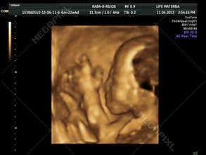 4D ultrasound scan of a baby playing in the womb