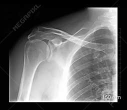 Shoulder xray
