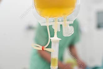 Giving fresh frozen plasma blood components during surgery