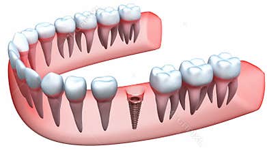 Implant is embedded in the gum