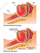 Obstructive sleep apnea