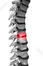 Back pain