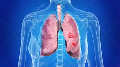 Lung cancer