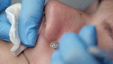 The beautician makes a cleansing of the nose area during the procedure of mechanical facial cleansing