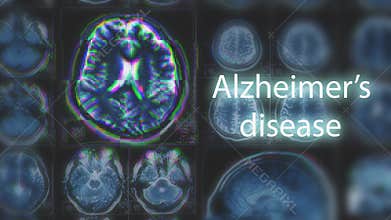 Alzheimer`s disease or Parkinson concept. Blurred MRI scan of brain with glitch effect