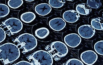 MRI of brain and cranium