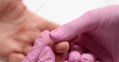 Doctor examines patient finger with dry cracked skin