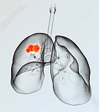 Lung cancer, medically 3D illustration on light background