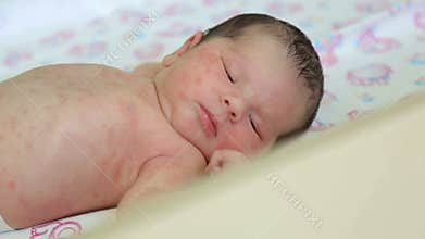 Close-up of a newborn baby with skin Allergy lying on the bed in the hospital.