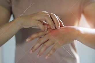 Healthcare and medical concept. Female scratching the itch on her hand, cause of itching from skin diseases.
