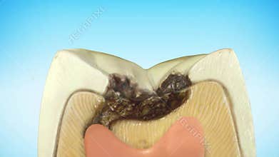 Molar tooth damaged by caries. Medically accurate tooth 3D animation