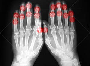 Plain film, radiography, of both hands, arthritis