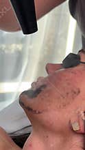 Young woman getting carbon laser facial at beauty clinic. Professional skincare