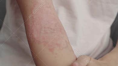 Woman applies a dermatitis cream