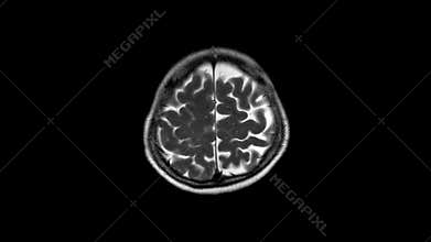 Mri and mrv of the brain: history a case presented with weakness and dysarthria, to rule out stroke.