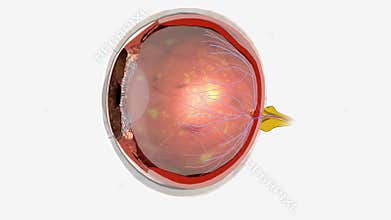 Diabetic retinopathy is an eye condition that can cause vision loss and blindness in people who have diabetes