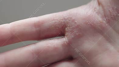 close-up dry cracked skin palm hand inflammation psoriasis dermatitis or eczema