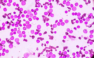 JBlood smear under microscopy showing on Adult acute myeloid leukemia AML is a type of cancer in which the bone marrow makes abn