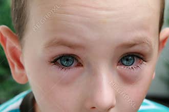 Allergy and conjunctivitis