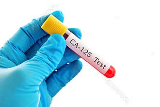 CA-125 test