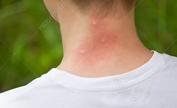 Mosquito bites. Girl with blond hair, sitting with his back to turn. Close-up of visible red, swollen neck skin from mosquito bite