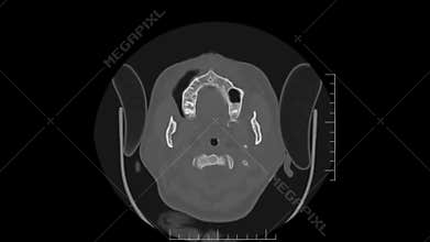 Orbit CT Scan Plain Bone Thin Sequence