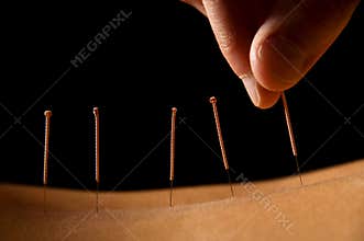 Acupuncture