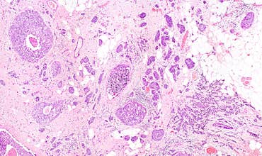 Breast cancer microscopy