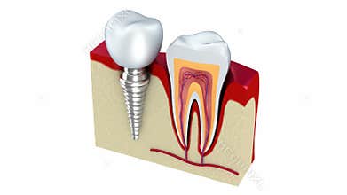 Anatomy of healthy teeth and dental implant in jaw bone.