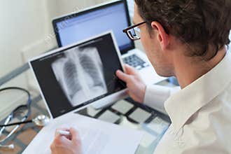 Doctor looking at x-ray of lungs, cancer diagnosis