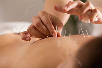 The doctor sticks needles into the girl`s body on the acupuncture - close up