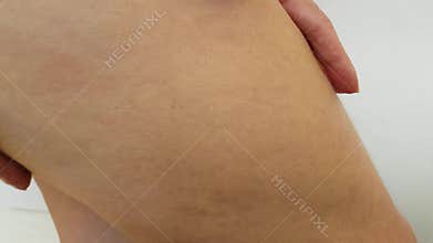 Legs of a woman cellulite, cream, weight hands