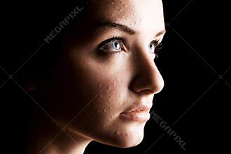 Female acne sufferer