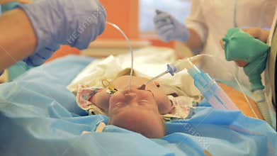 A nurse installs a breathing tube inside infants nose.
