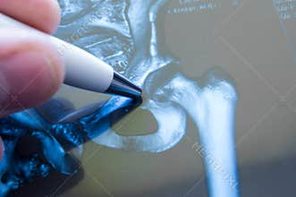 X-ray of hip joint. Doctor pointed on area of hip joint, where pathology is detected, such as fracture, destruction of joint, coxa