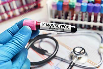 Doctor with a blood sample in a tube diagnosed with Monkeypox MPXV disease
