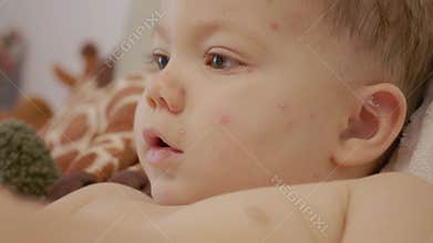 Child with chickenpox showing blisters on face during sickness at home